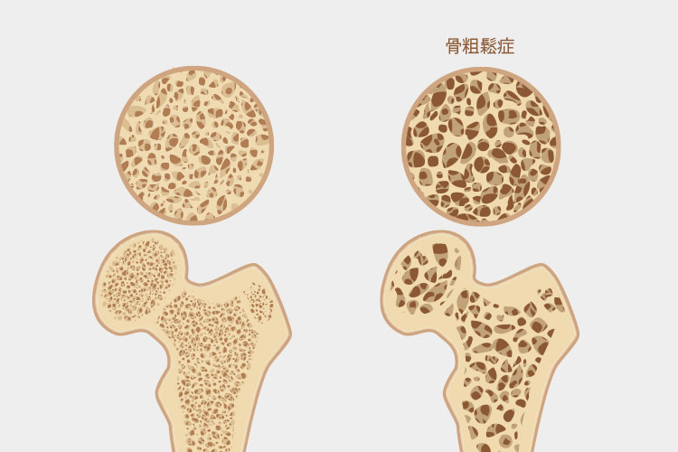 骨粗しょう症のイメージ写真